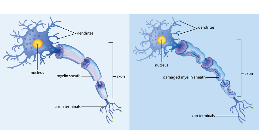 Side-by-side diagram of a healthy myelinated neuron and an ADLD-damaged neuron showing damaged myelin sheath