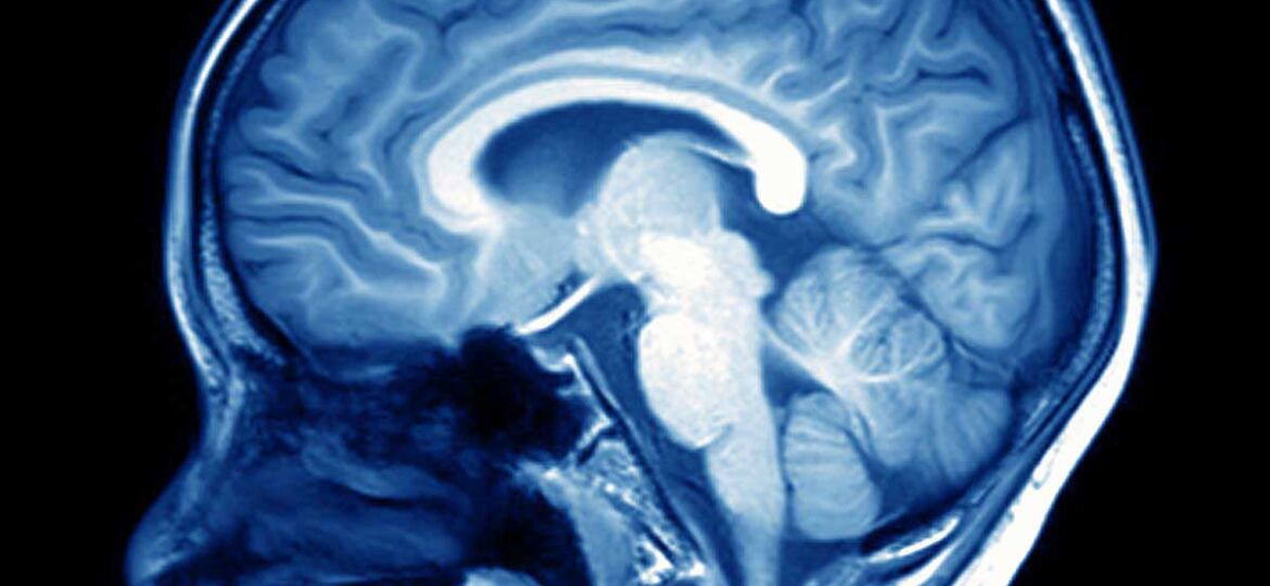 brain-scan-2919925176-2